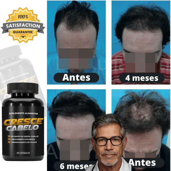 💇‍♂️💇‍♀️ Leve 3, pague 2 - Cresce Cabelo 500mg!